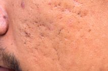 01-icepick-the-5-types-of-acne-scars-and-how-to-treat-them-211513207-only-background-760x506