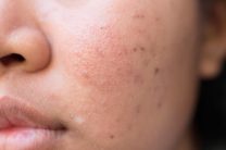 05-hyperpigmentation-the-5-types-of-acne-scars-and-how-to-treat-them-435055855-frank60-1024x683